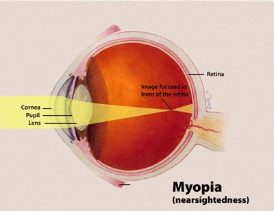 comment la myopie fonctionne